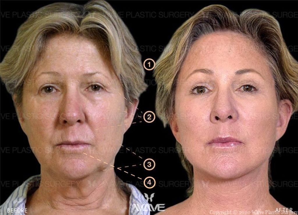 Photo of woman before and after Wave Facelift
