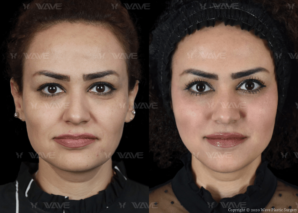 NewLift before and after