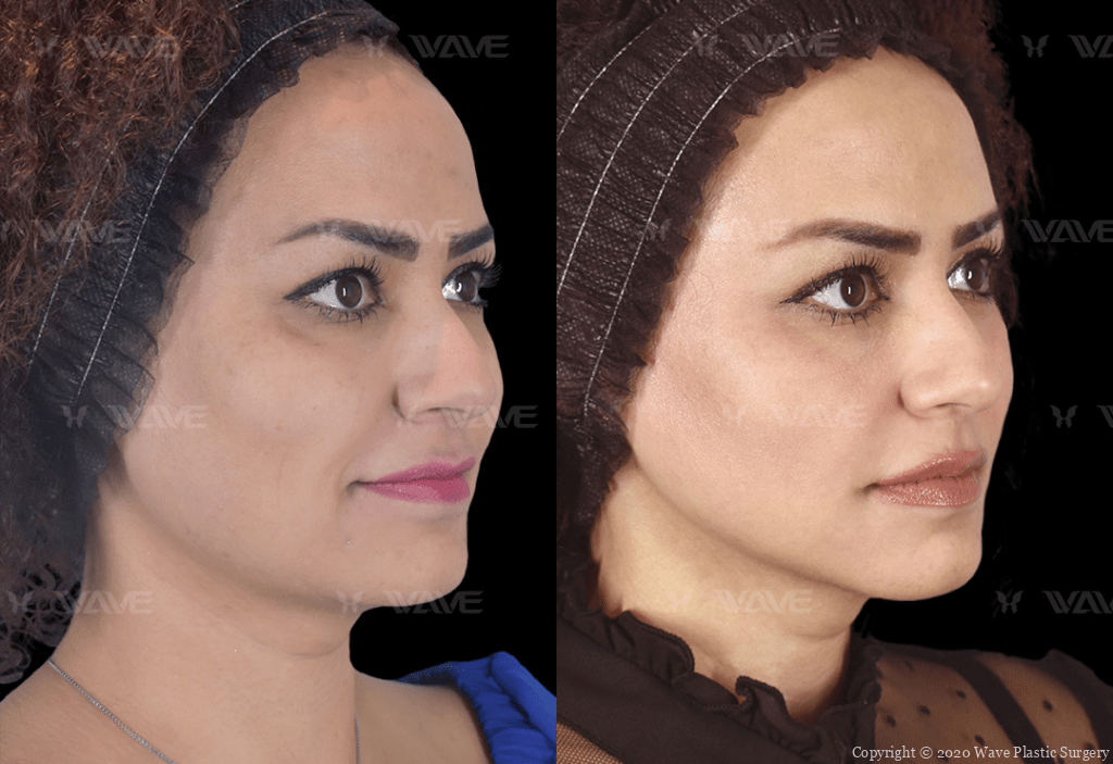 NewLift before and after