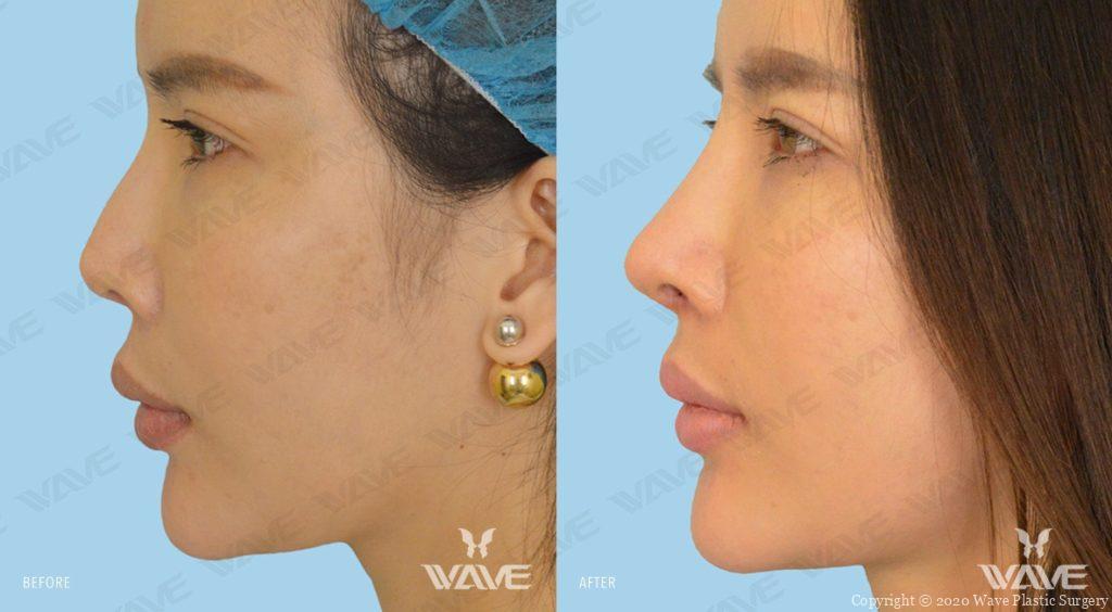 Rhinoplasty before and after