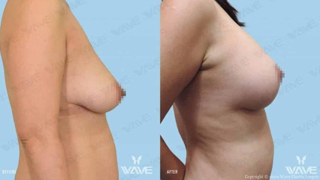 breast life before and after