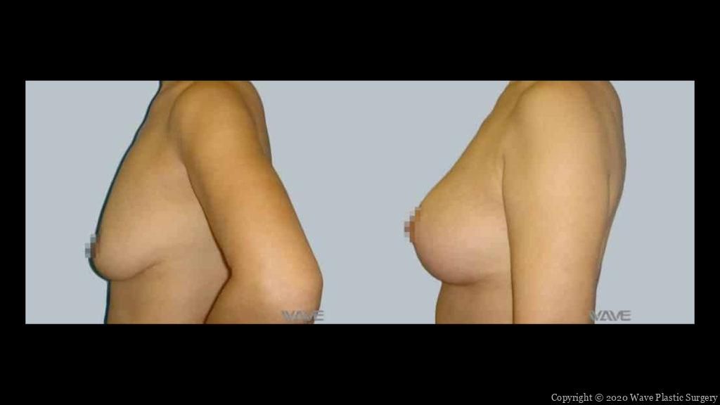 breast lift before and after