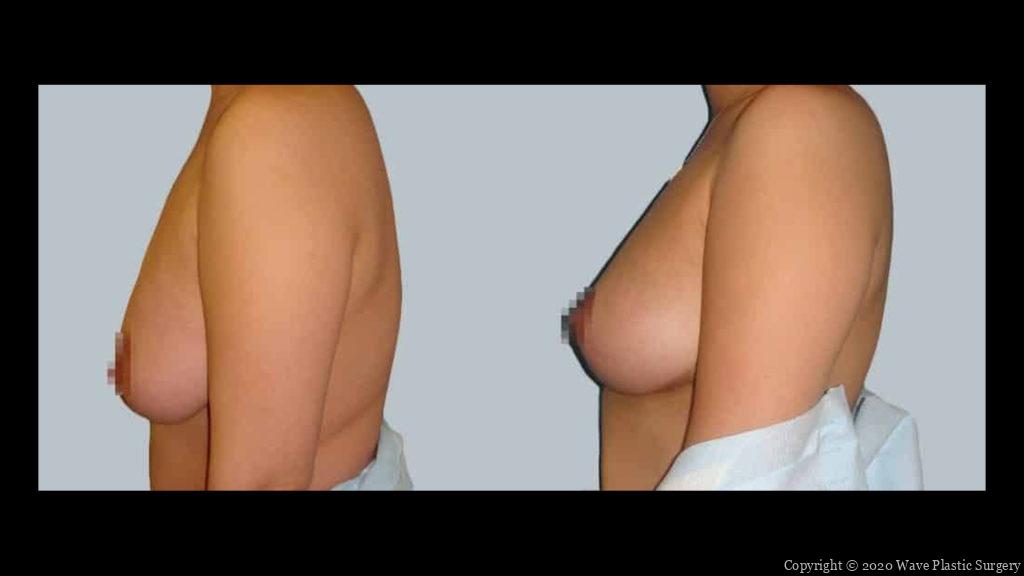 breast life before and after
