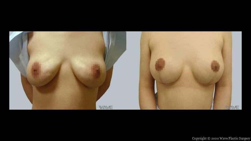 breast lift before and after