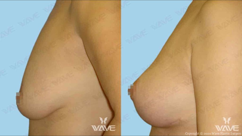 breast lift before and after
