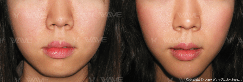 Chin Augmentation before and after
