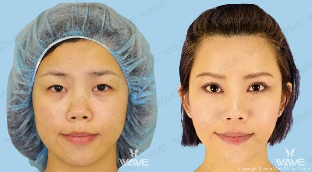 Double Eyelid surgery before and after