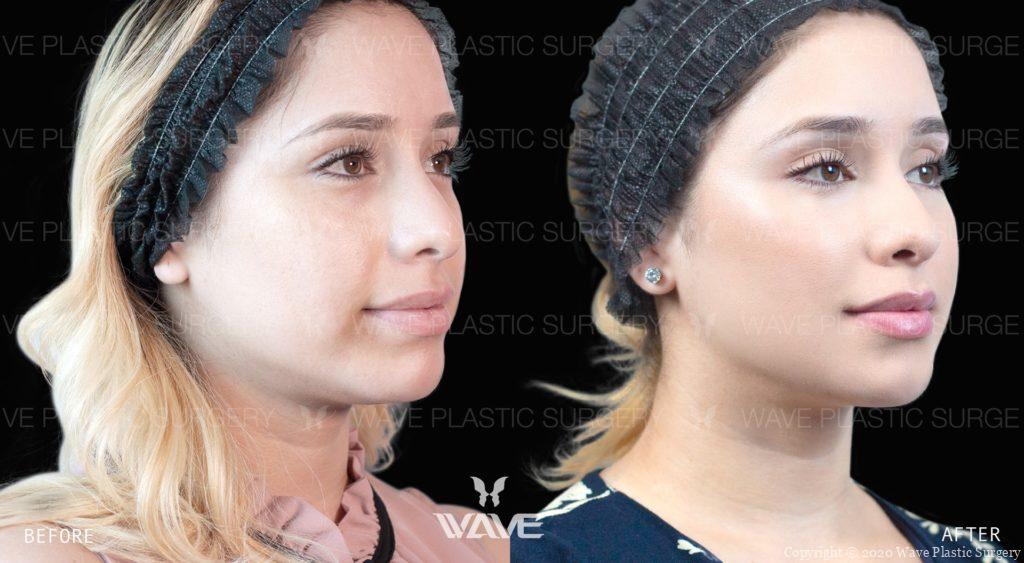 Filler before and after