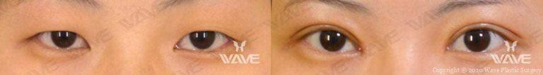 asian double eyelid surgery before and after