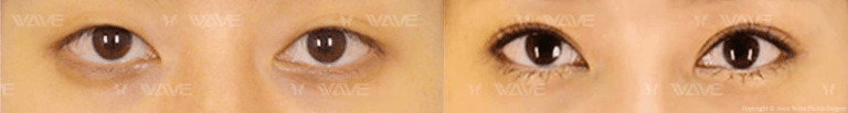 asian double eyelid surgery before and after