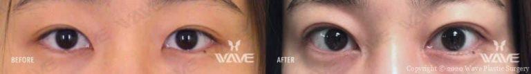 asian double eyelid surgery before and after