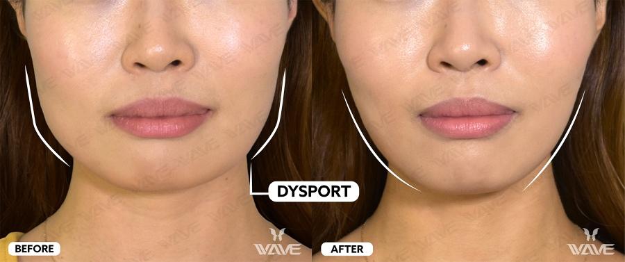 dysport before and after