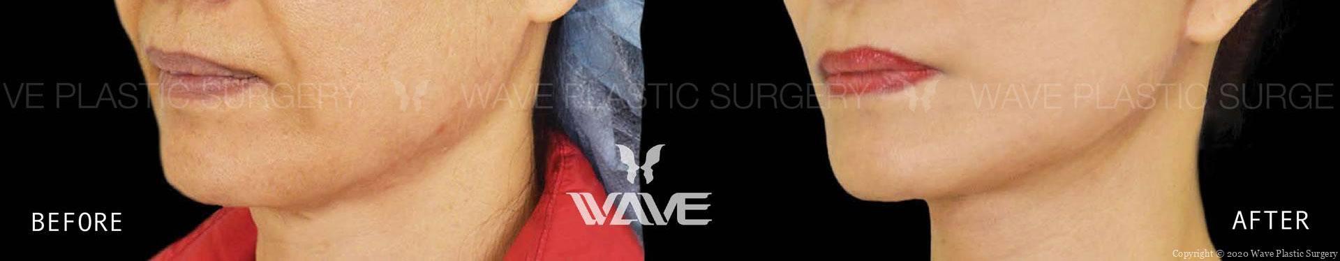 Face Necklift BA Website Watermark 01 scaled 1