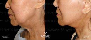 Face Necklift BA Website Watermark 02 scaled 1