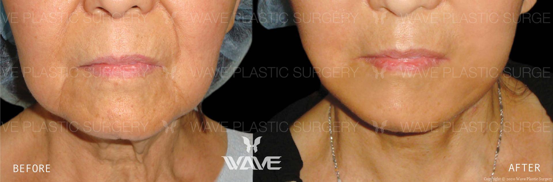 Face Necklift BA Website Watermark 03 scaled 1