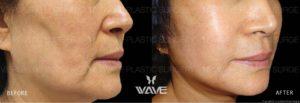 Face Necklift BA Website Watermark 04 scaled 1