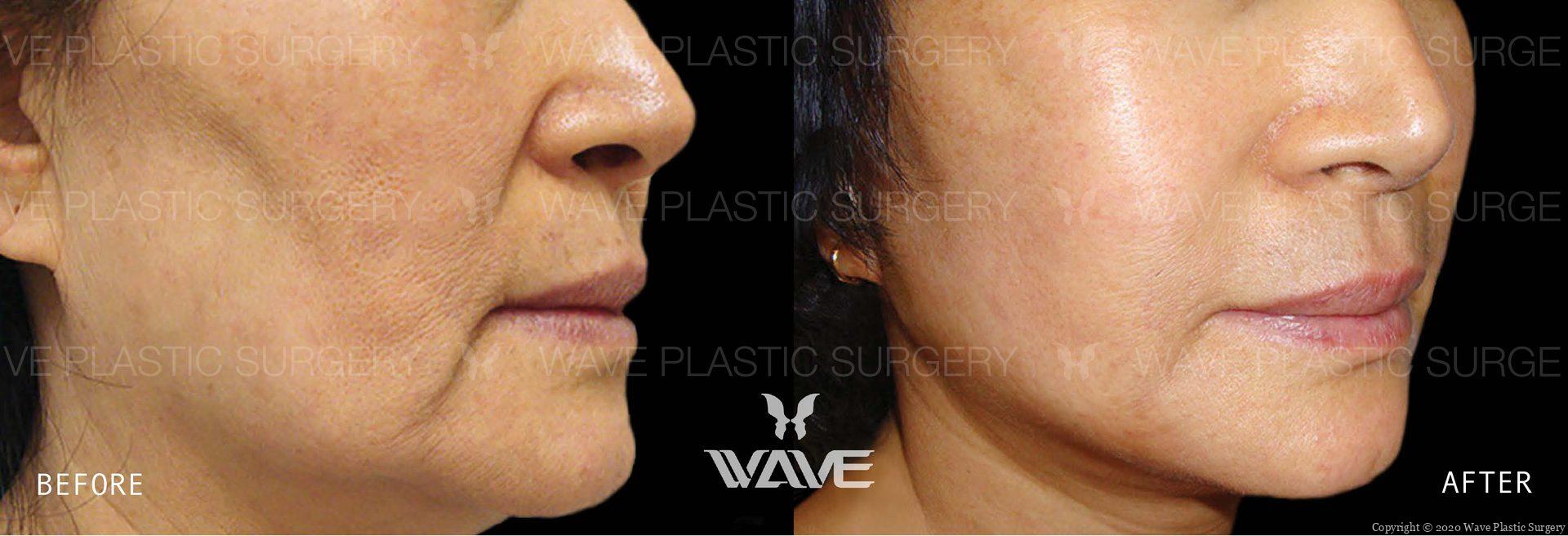Face Necklift BA Website Watermark 04 scaled 1