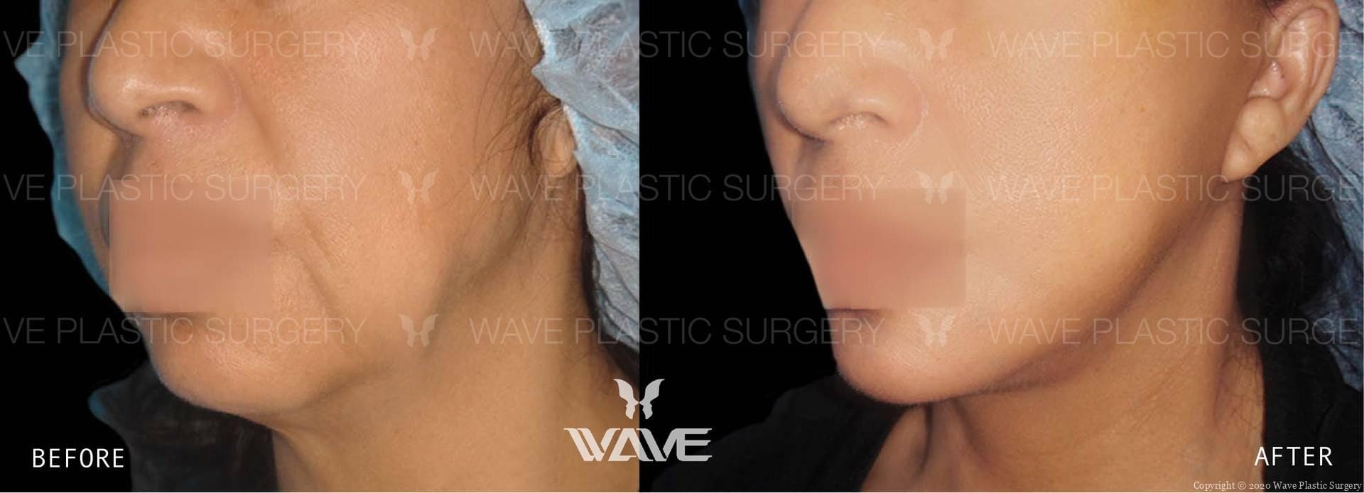 Face Necklift BA Website Watermark 05 scaled 1