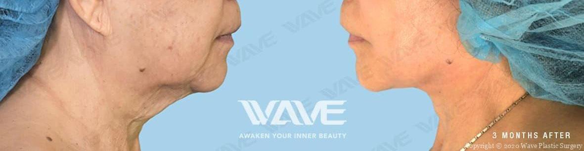 Face necklift 01c