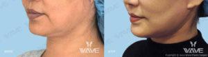 Face necklift 03b