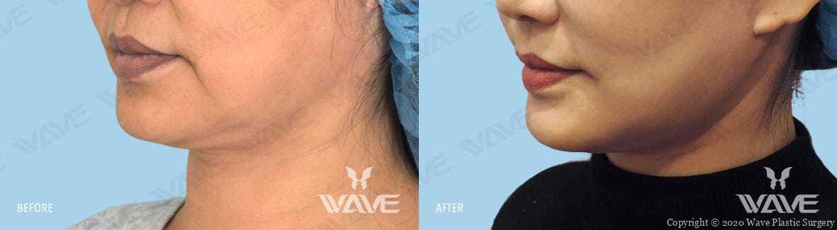 Face necklift 03b