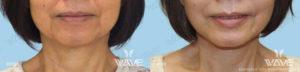 Face necklift 04b