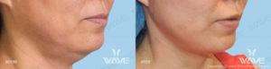 Face necklift 05a