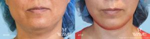 Face necklift 05b