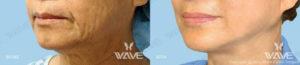 Face necklift 06