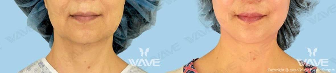 Face necklift 07c