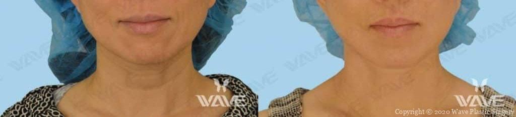 Face necklift 08
