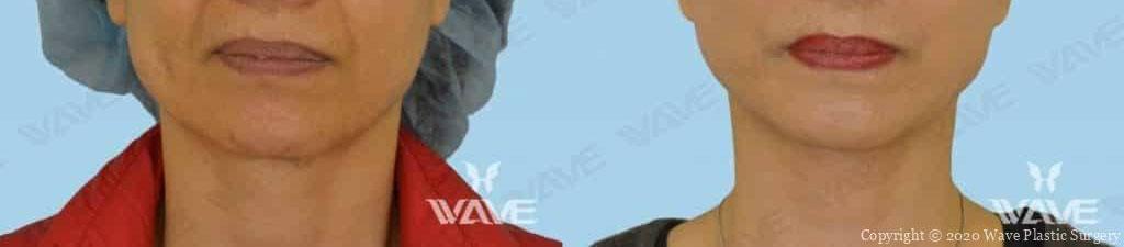 Face necklift 11