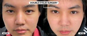 double eyelid surgery before and after