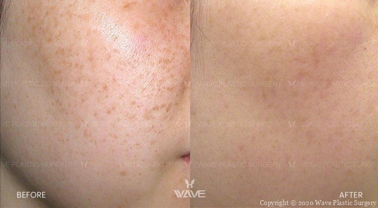 lumecca before and after patient photo