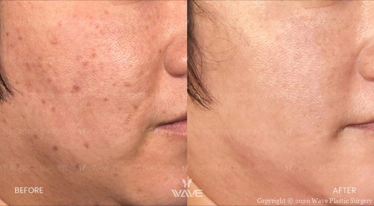 lumecca before and after patient photo