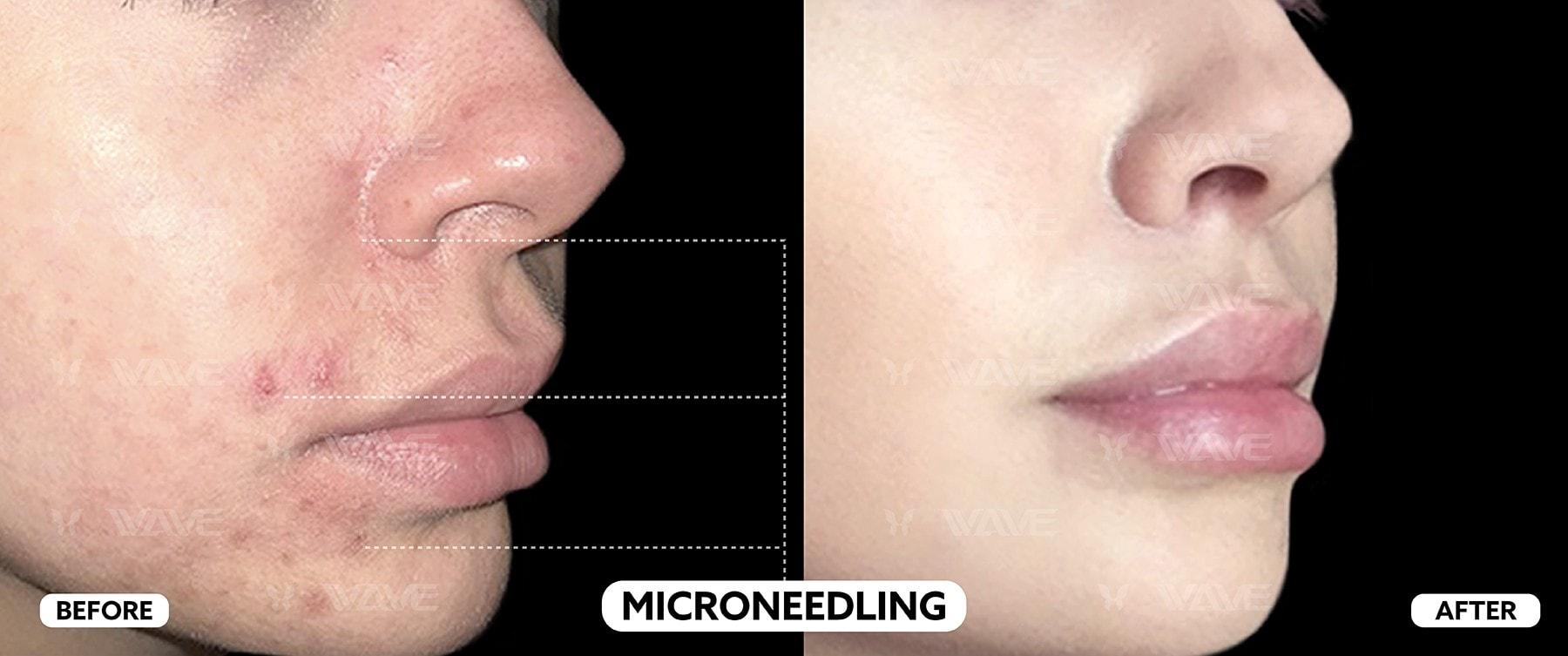 MICRONEEDLING before and after