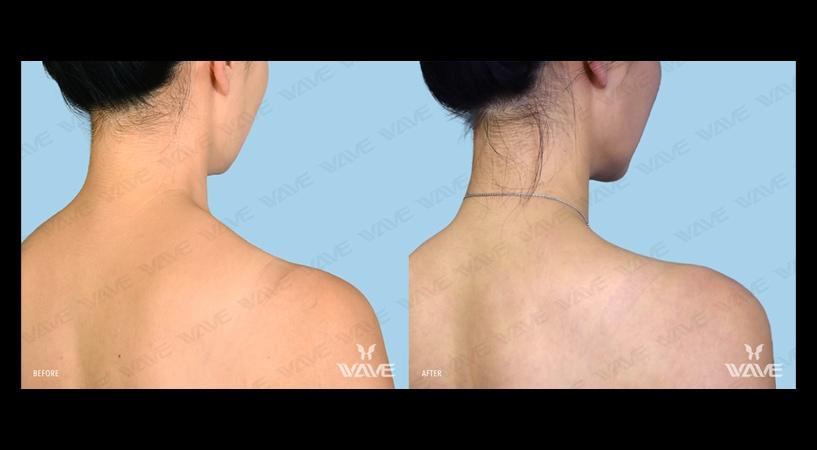 Neuromodulators dysport before and after 0102