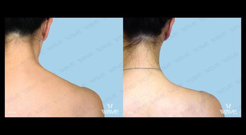 Neuromodulators dysport before and after 0103