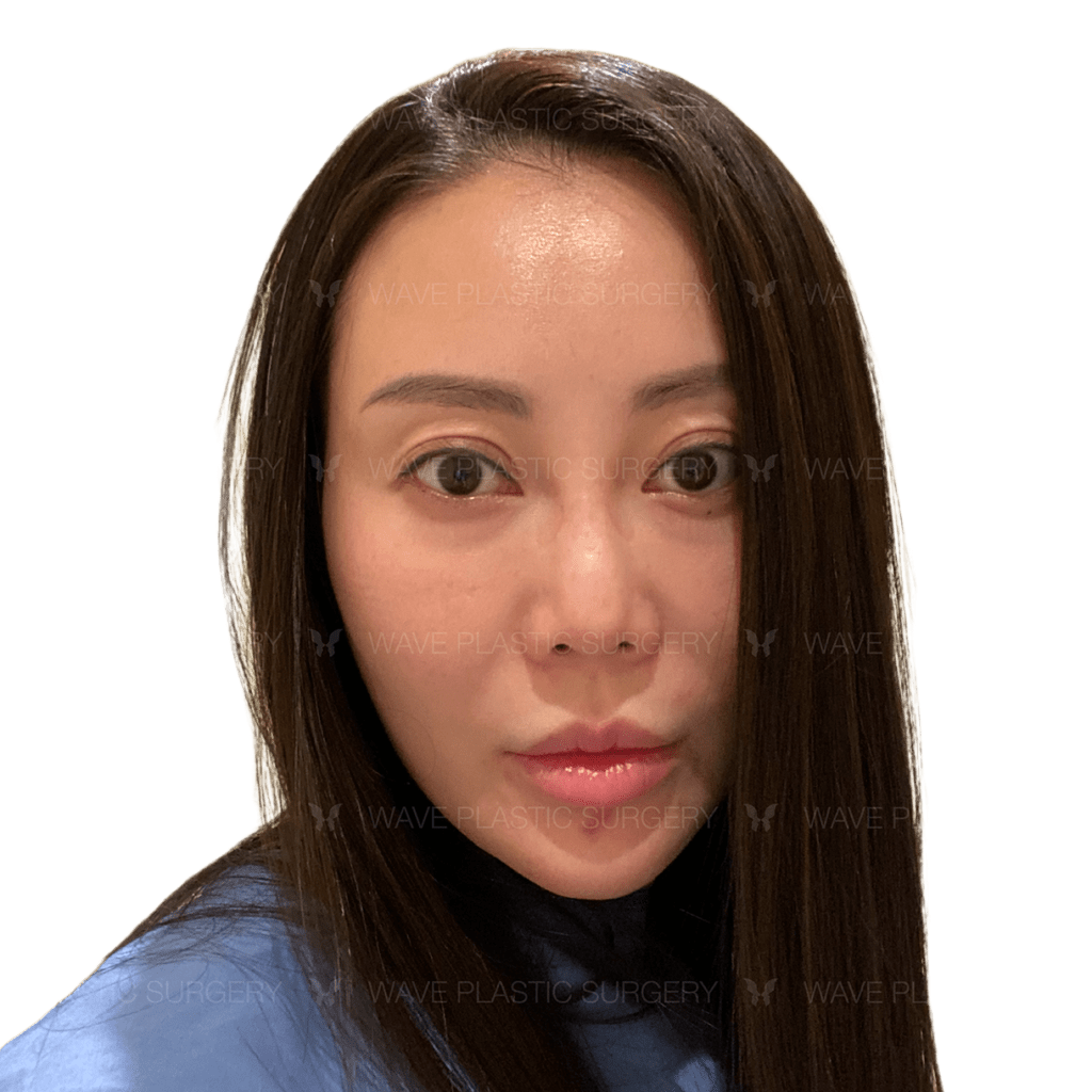 Anti-Aging Treatments For People in Their 30s, 40s, 50s, 60s, and 70s 40s 1