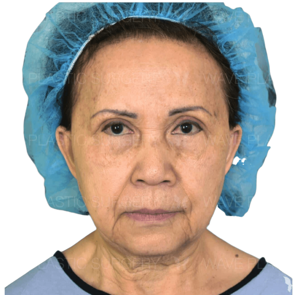 Anti-Aging Treatments For People in Their 30s, 40s, 50s, 60s, and 70s 70s 3