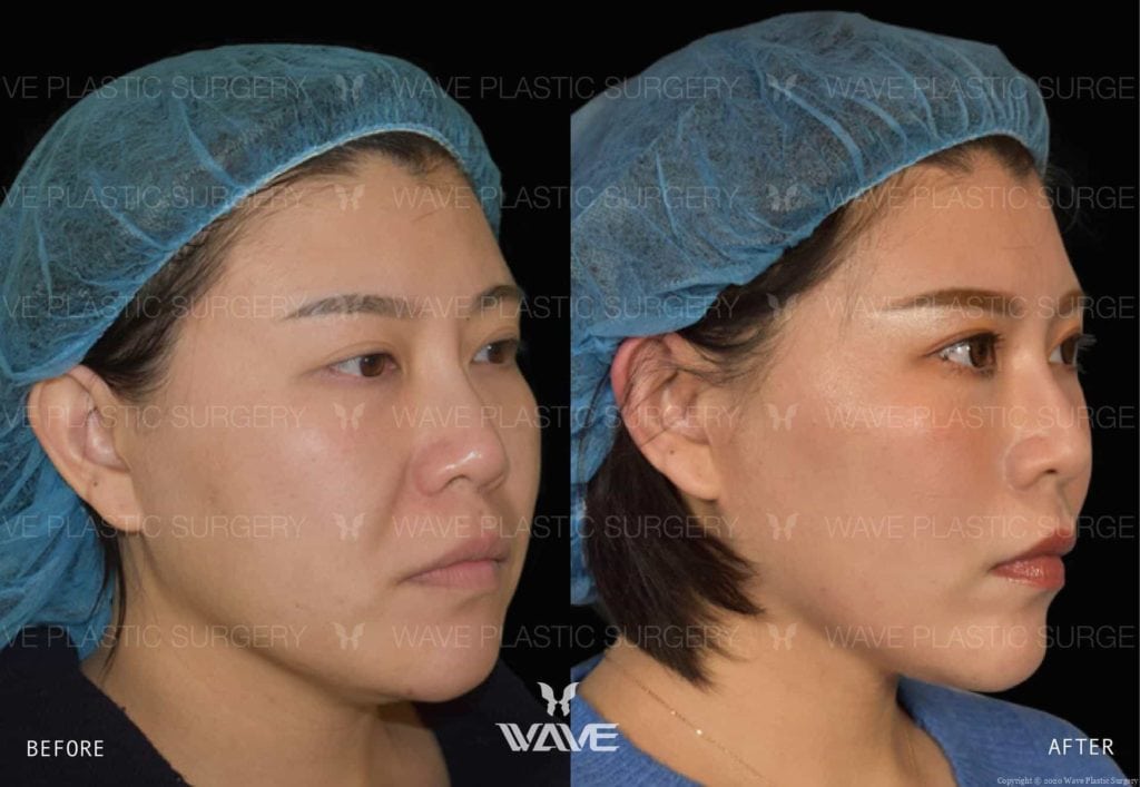 Anti-Aging Treatments For People in Their 30s, 40s, 50s, 60s, and 70s Flash Lift 1