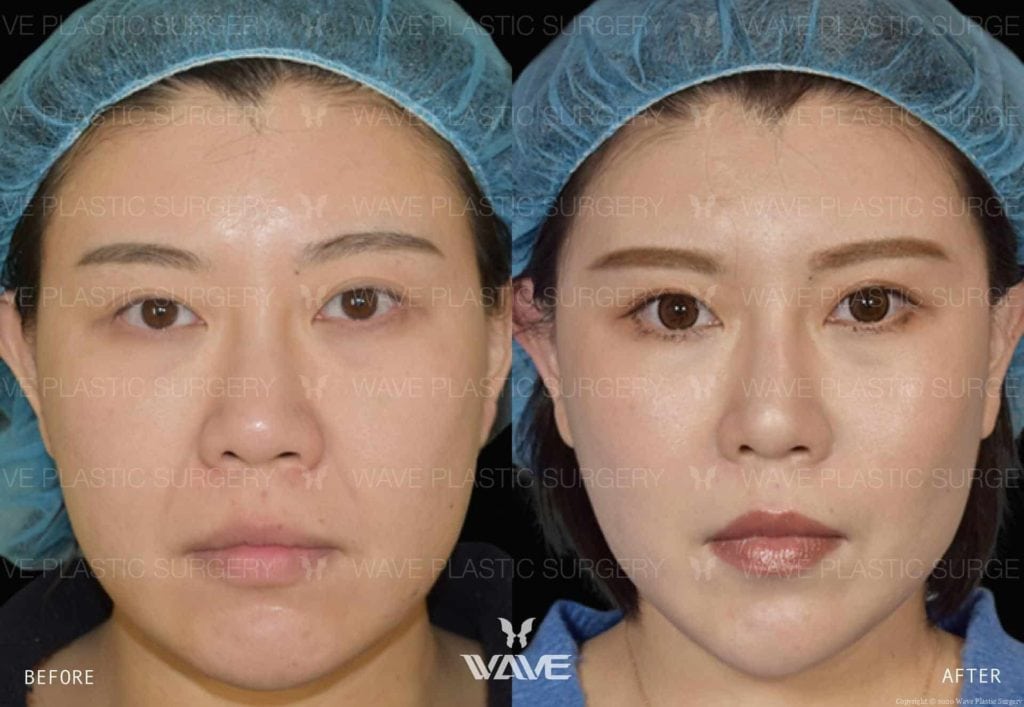 Anti-Aging Treatments For People in Their 30s, 40s, 50s, 60s, and 70s Flash Lift 2 copy 2