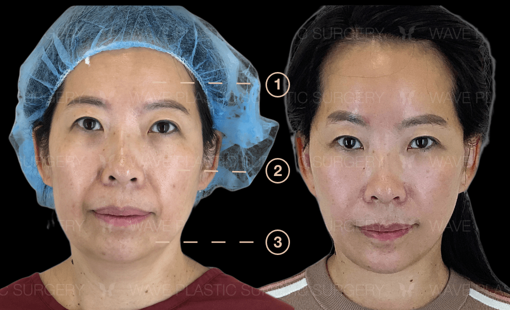 Anti-Aging Treatments For People in Their 30s, 40s, 50s, 60s, and 70s Group 121