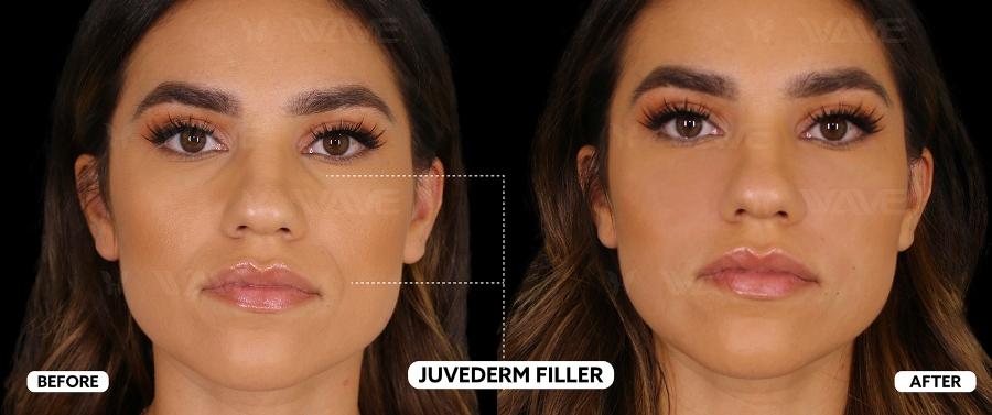 Reverse the Clock with the Best Non-Surgical Anti-Aging Treatments in 2025 JUVEDERM