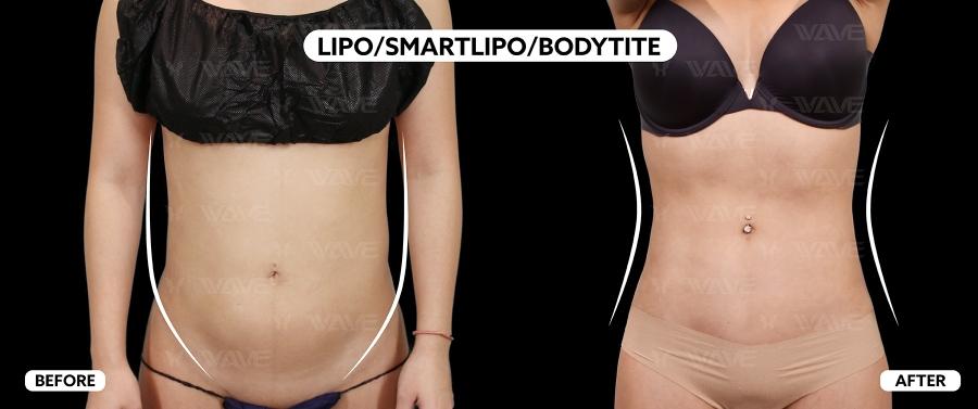 before and after results after liposuction, smartlipo, and bodytite