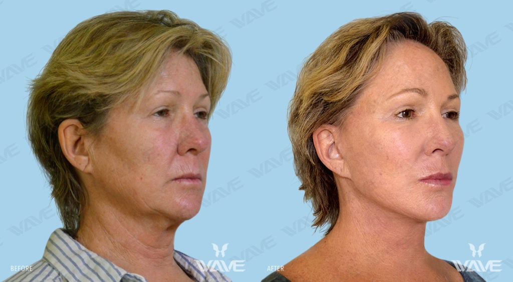 Anti-Aging Treatments For People in Their 30s, 40s, 50s, 60s, and 70s OTTONE KIM FL FULL 2