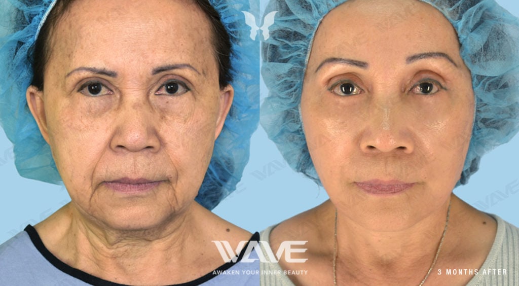 Anti-Aging Treatments For People in Their 30s, 40s, 50s, 60s, and 70s QUACH TRACY FL NL LB ENDO BL 1181x650 F1