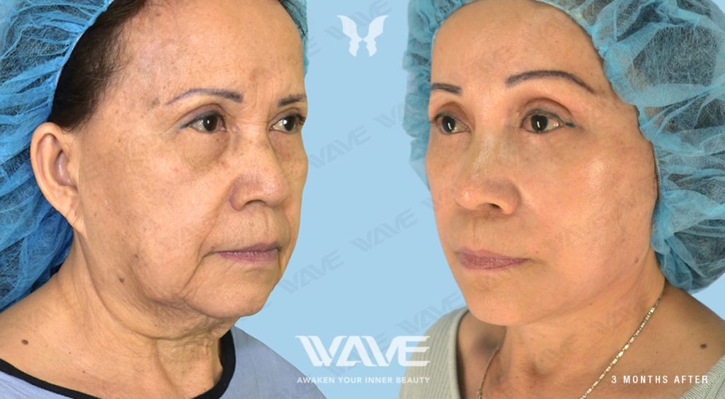 Anti-Aging Treatments For People in Their 30s, 40s, 50s, 60s, and 70s QUACH TRACY FL NL LB ENDO BL 1181x650 F2