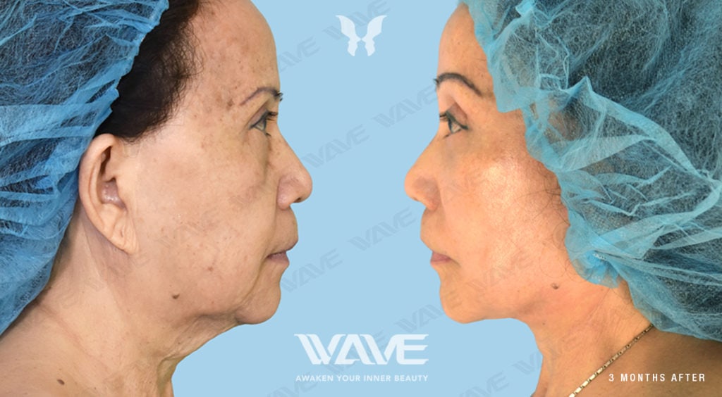 Anti-Aging Treatments For People in Their 30s, 40s, 50s, 60s, and 70s QUACH TRACY FL NL LB ENDO BL 1181x650 F3