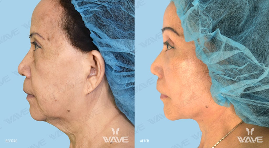 Anti-Aging Treatments For People in Their 30s, 40s, 50s, 60s, and 70s QUACH TRACY FL NL LB ENDO BL 1181x650 F6